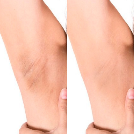 Peeling axila 40%