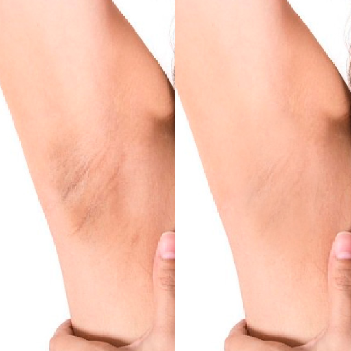 Peeling axila 40% - Dra. Esbeydy Dermatóloga