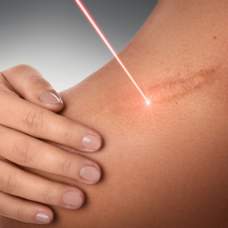 Laser cicatriz 25%